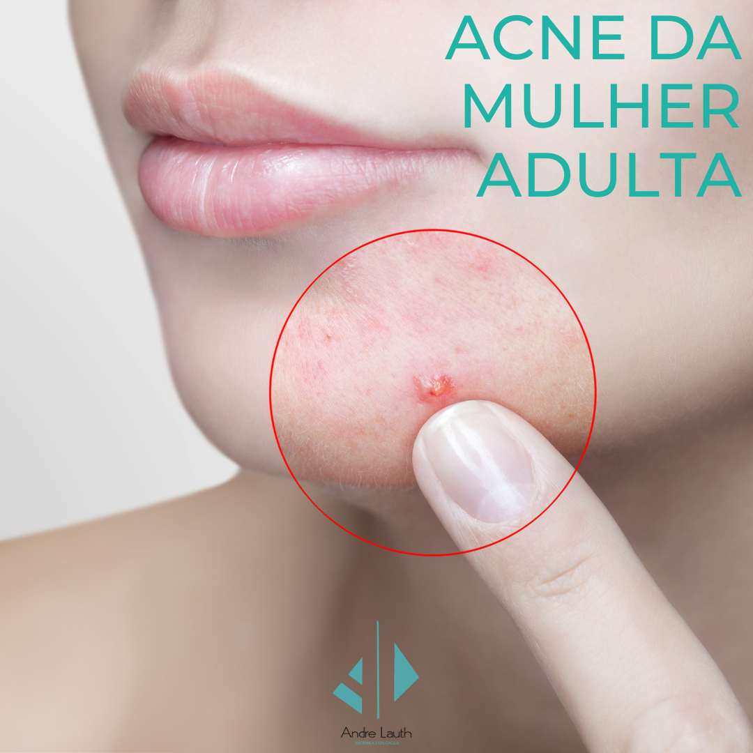 3.-Acne-da-mulher-adulta.png