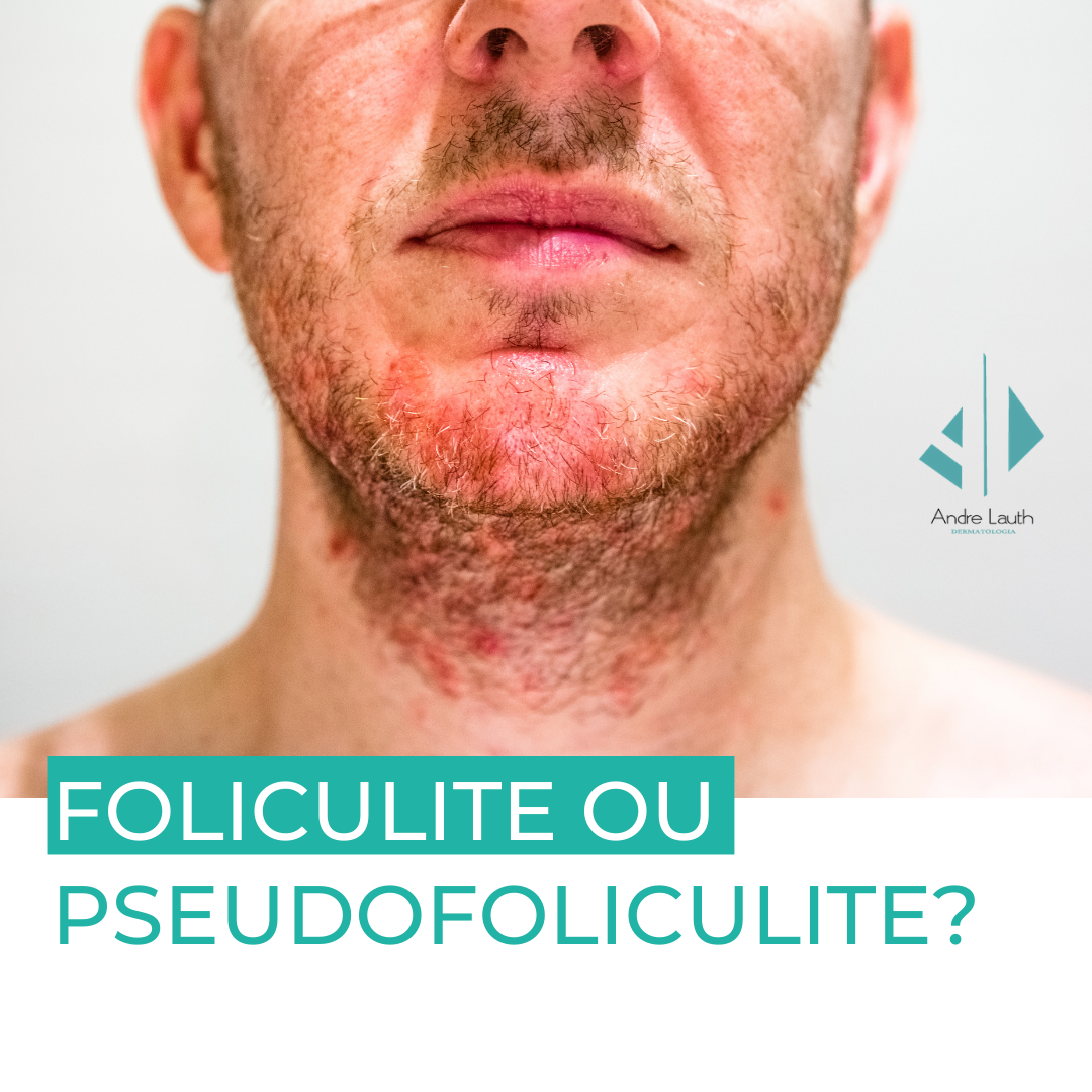 4.-Foliculite-ou-pseudofoliculite.png