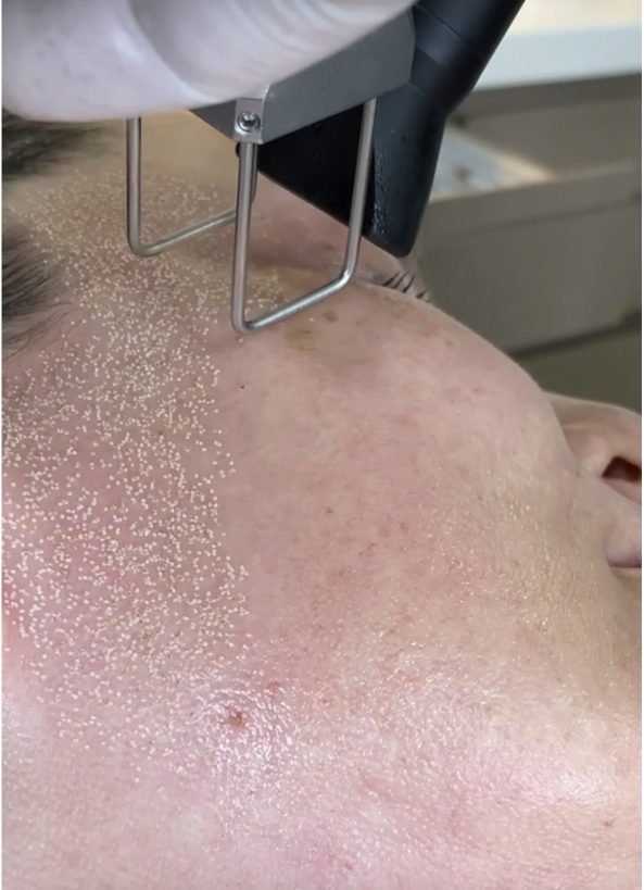 lase co2 curitiba lase co2 curitiba