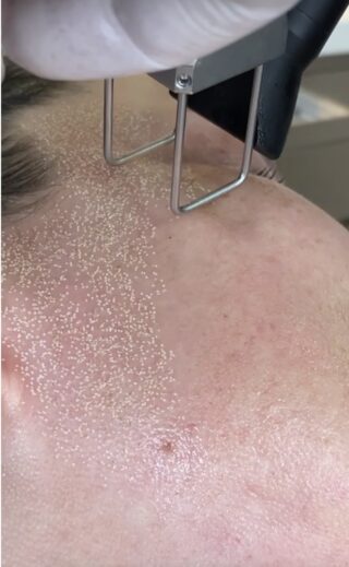 laser de co2 curitiba