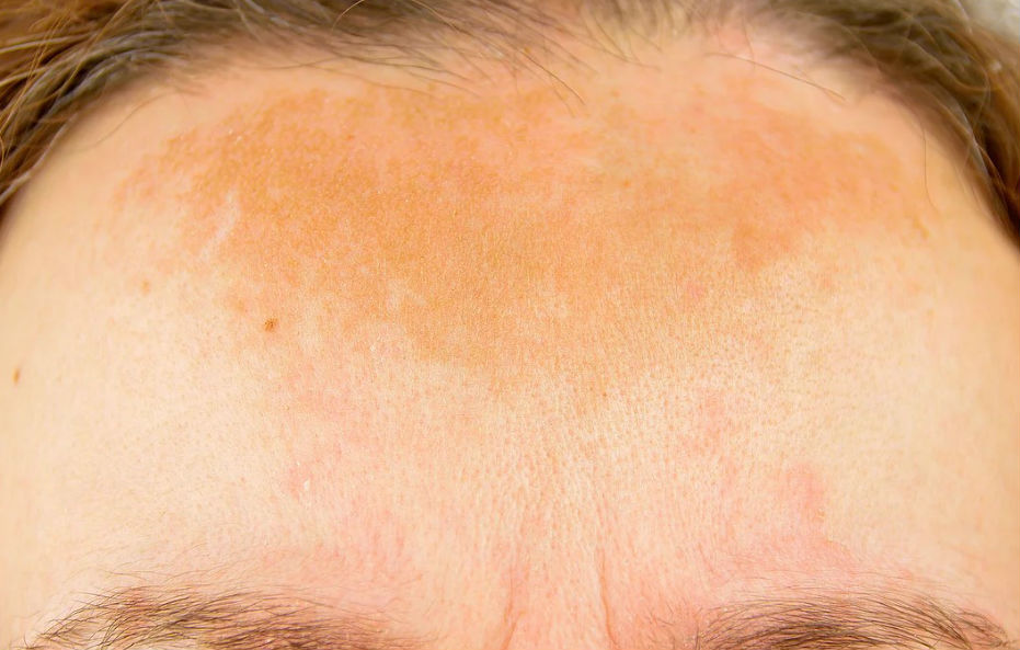 Dermatologista Curitiba - Dr. André Lauth - Tratamento de Melasma