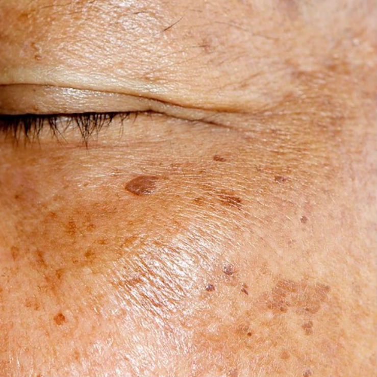 Melasma-o-que-voc-precisa-saber.jpg