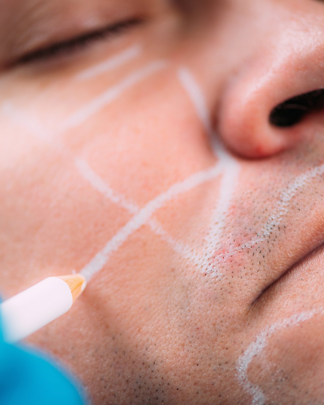 preenchimento-facial-curitiba.png